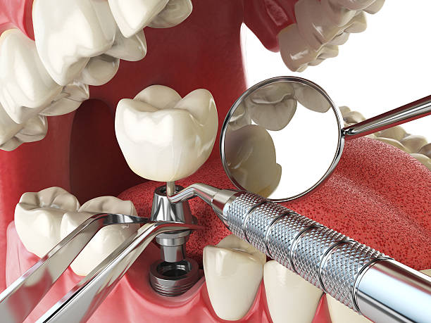 Best Lost Filling or Crown Replacement in Miles, TX